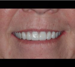 New Smile After Dental Implant